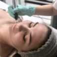 avra-institute-microneedling