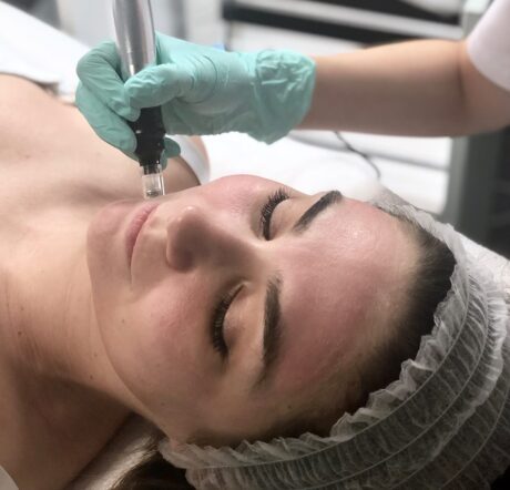 avra-institute-microneedling